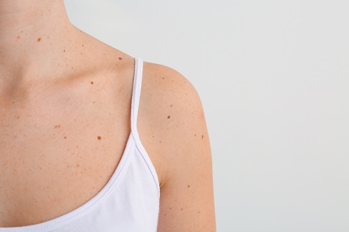 Доброкачественные новообразования кожи