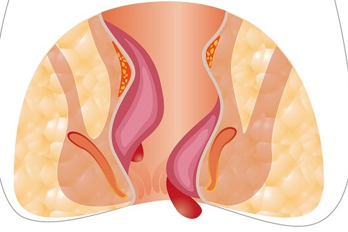 Симптомы геморроя