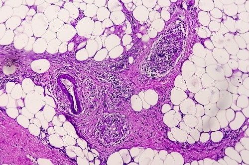 Этапы развития гранулемы