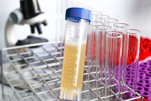 Анализ мочи при подагре Анализ мочи при подагре